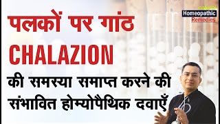 पलकों पर गांठ  Chalazion  Natural homeopathic remedies with symptoms [upl. by Augustus511]