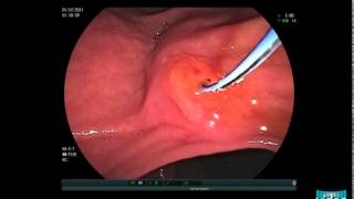 Choledocholithiasis  Sphincterotomy and Stone Extraction with a Basket [upl. by Esahc]