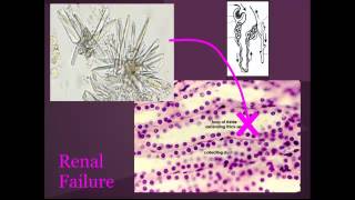 Tumor Lysis syndrome quotEM in 5quot [upl. by Lisabeth]