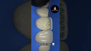 Dr Incisor Dentine layering dental dentist dentistry smile teeth dentalcare dentalclinic [upl. by Alliehs717]