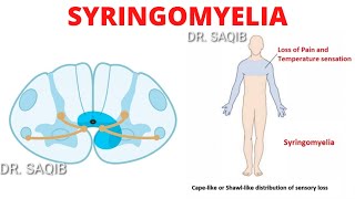 Syringomyelia [upl. by Sloane]