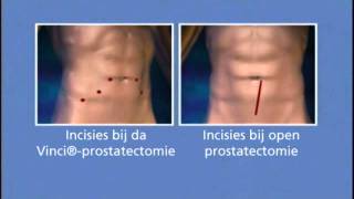 Robotchirurgie van de prostaat Isala in Zwolle [upl. by Thorvald]