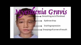 Myasthenia gravis mrcpch Clinical [upl. by Houston330]