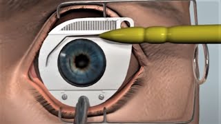 LASIK eye surgery  3D animation [upl. by Katonah820]