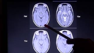 Grundlagen und Unterscheidungsmerkmale zu wichtigen MRT Sequenzen [upl. by Calendra]