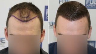 FUE Hair Transplant 2700 Grafts in NWClass lllA Dr Juan Couto  FUEXPERT CLINIC Madrid Spain [upl. by Lightman]