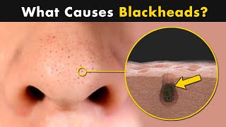 What Causes Blackheads on Our Skin  Symptoms Causes And Treatment [upl. by Ilenna90]