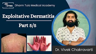 Dermatitis  Exfoliative Dermatitis Hindi  Types  Part 55 Eczema  Skin Disease  Skin Infection [upl. by Perceval]