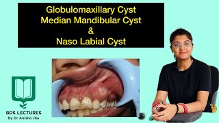 Globulomaxillary Cyst  Median Mandibular Cyst  Naso Labial Cyst  Lecture 16  Oral Pathology [upl. by Auqinet]