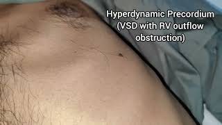 Hyperdynamic Precordium Video [upl. by Mayer668]