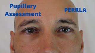 Pupillary Assessment PERRLA [upl. by Florri334]