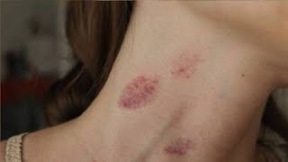 how to give someone a hickey simple step by step tutorial [upl. by Amluz]