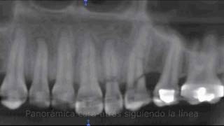 Tomografía de fracturas dentales  RXORAL 3D [upl. by Wait]