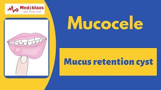 Mucocele l clincial features Histopathology treatment l Oral pathology l Mediklaas [upl. by Marguerita]