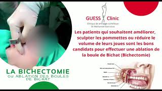 LA BICHECTOMIE POUR DES JOUES CREUSES  DR GUESSOUS [upl. by Otcefrep]