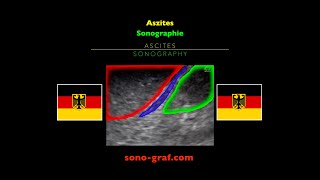 Sonographie Aszites [upl. by Nosyerg443]