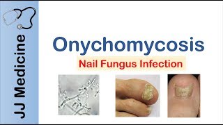 Onychomycosis  Nail Infection  Signs Symptoms Treatment [upl. by Joannes]