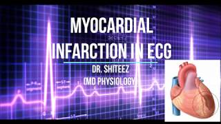 Myocardial Infarction MI ECG in HIndi [upl. by Dyrrej]