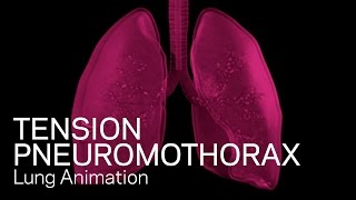 Tension Pneumothorax  Medical Animation [upl. by Inava]