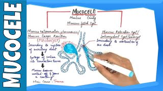 Mucocele  Types Clinical Features Histopathalogic features amp Treatment [upl. by Yderf]