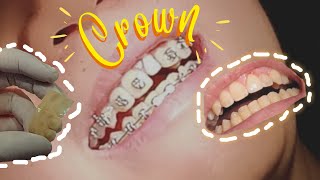 How does PORCELAIN CROWN works [upl. by Sihon]