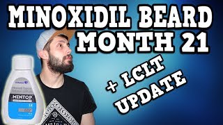 Minoxidil Beard Growth Results  LCLT UPDATE  Month 21  TheJourneyContinues [upl. by Vita]