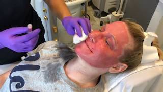 TRL Laser For A Dramatic Skin Rejuvenation [upl. by Drake94]