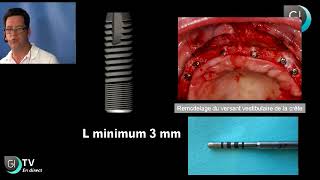 Implants Dentaires  Lexpansion osseuse [upl. by Reerg]