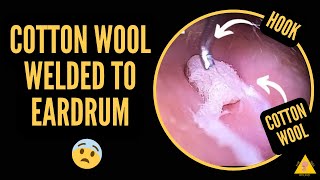 Watery ear wax Ear wax removal camera buzzfeed ear wax extraction OtoSet® Ear Cleaning ear wax [upl. by Stew]