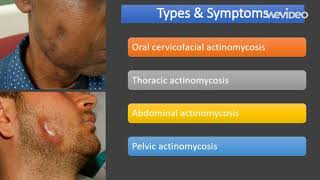 actinomycosis  Introduction Types Symptoms [upl. by Velasco]