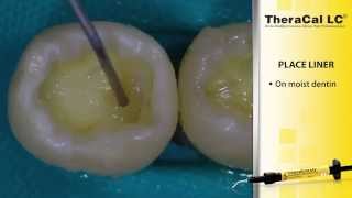 Exposed Dental Pulp Case Using TheraCal PT [upl. by Lerrud40]