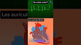 cómo ver una fibrilación auricular en el electrocardiograma cardiología medicina short urgencias [upl. by Marnia837]