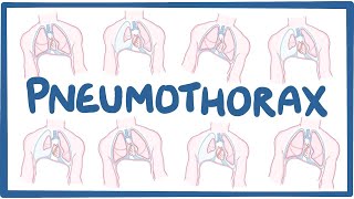 Pneumothorax  causes symptoms diagnosis treatment pathology [upl. by Akemihs624]