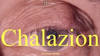 Chalazion [upl. by Ecinrev233]