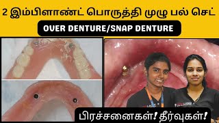 24 இம்பிளாண்ட் பொருத்தி OverdentureSnap denture dentist implant [upl. by Compte]