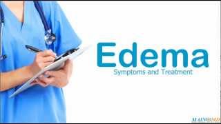 Edema Symptoms and Treatment [upl. by Courtney154]