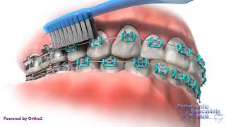 Proper Brushing  Orthodontic Care Instructions [upl. by Nireil960]