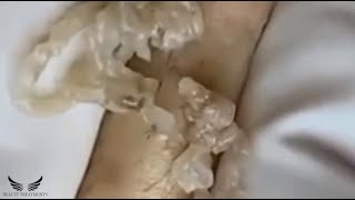 Severe Blackhead Removal  Acne Cystic Treatment  Elderly Acne Spa  Pimple Popping Videos  071 [upl. by Refinnaej319]