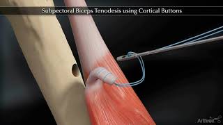 Subpectoral Biceps Tenodesis Using Cortical Buttons [upl. by Rozamond]