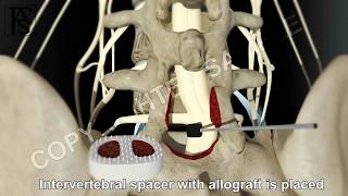 Lumbar Fusion of L5 S1 Posterior [upl. by Allianora]