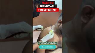 Warts Removal Treatment  Ayurawa Ayurveda DrGayathri Kooragoda treatment ayurveda [upl. by Htrag]