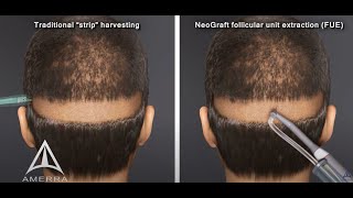 NeoGraft hair transplant procedure  animation [upl. by Lu]