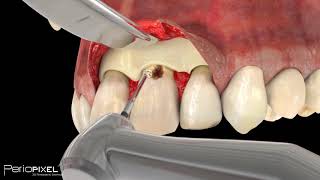 Avance vídeo completo quotCaries Subgingivalquot  PerioPixel [upl. by Rambert446]