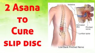 How to Cure Slipped Disc [upl. by Vharat]