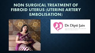 Non Surgical Treatment of Fibroid Uterus UTERINE ARTERY EMBOLISATION [upl. by Baelbeer]