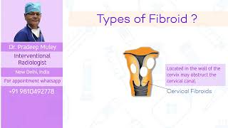 Symptoms of fibroids and various treatment options [upl. by Hilliary]