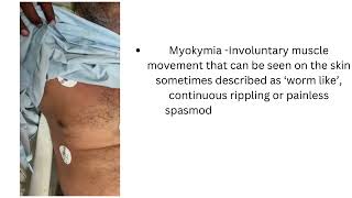 MYOKYMIA IN A CASE OF GUILLAIN BARRE SYNDROME [upl. by Myna]