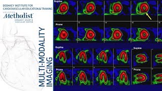 Nuclear Cardiology Understanding the Basics John J Mahmarian MD October 16 2018 [upl. by Tdnarb]