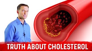 The Truth About Cholesterol – LDL Cholesterol amp HDL Cholesterol – DrBerg [upl. by Fridlund]