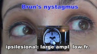 Bruns nystagmus [upl. by Krasner]